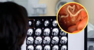 El calvario de una inglesa con neurocisticercosis y 38 parásitos en su cerebro tras un viaje a India